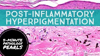 PostInflammatory Hyperpigmentation Pigment Incontinence 5Minute Pathology Pearls [upl. by Amalea674]