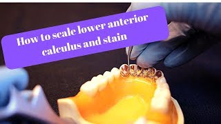 How to scale mandibular anterior calculus and stain [upl. by Evered]