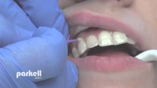 Desensitizing tooth surfaces using BrushampBond or PainFree F [upl. by Wack]