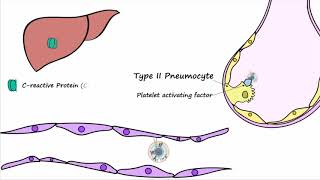 Bacterial Pneumonia  Pathogenesis [upl. by Ajiat]