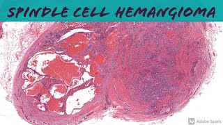 Spindle Cell Hemangioma 101 [upl. by Dloreg]