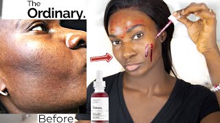 THE ORDINARY PEELING SOLUTION TEXTURE amp HYPERPIGMENTATION [upl. by Apfelstadt]