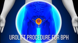 UroLift Procedure for BPH Chesapeake Urology [upl. by Uziel550]