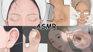 시각적 팅글 ASMR 모음집 여드름 피부관리 귀청소 내성발톱 치료  루루팡 [upl. by Haney53]