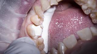 Biodentine  amalgam replacement on a large MOL cavity [upl. by Ailema]