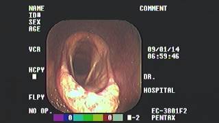 Epiglottic Entrapment [upl. by Noeht132]