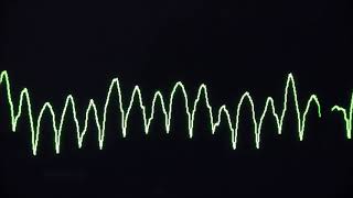 Cardiac arrest rhythms VF VT Asystole and PEA [upl. by Chu37]