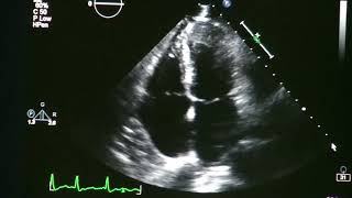 Atrial Fibrillation On Echocardiogram [upl. by Ahsineb]