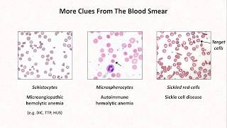 Anemia Lesson 4  Clues from the blood smear [upl. by Atinihc]