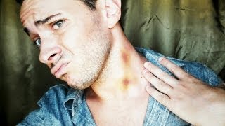 How to Remove a Hickey FAST  Tip 94 [upl. by Le44]