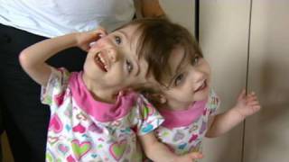 Conjoined Twins Twin Girls A Medical Wonder [upl. by Myranda790]