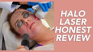 My Halo Laser Experience Honest Review Recovery and Before amp Afters [upl. by Ylrahc]