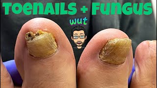 HOW TO CUT THICK TOENAILS WITH FUNGUS [upl. by Onaled]