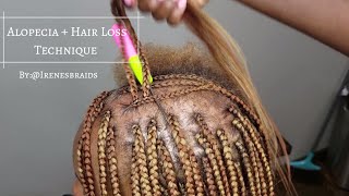 NEW TECHNIQUE ALOPECIA  HAIR LOSS BOX BRAIDS  IRENESBRAIDS [upl. by Rosalee]