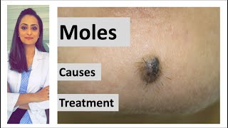 How to remove a mole  Mole causes amp removal  home remedy  Dermatologist  Dr Aanchal Panth [upl. by Saiff]