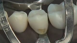 Class V Composite Preparation amp Restoration  Operative Dentistry [upl. by Loree686]