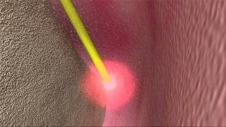 Laser Periodontal Therapy  WPT™ Animation [upl. by Nnilsia]