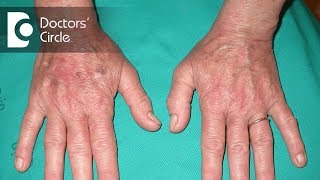 What is Lichen Planus and its clinical signs  Dr Satish DA [upl. by Kreager]