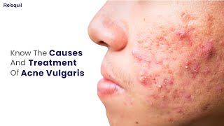 Causes And Treatment Of Acne Vulgaris [upl. by Malik]