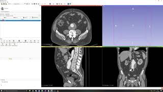 3D Slicer Tutorial 2 Manual segmentation Thresholding [upl. by Zacarias545]