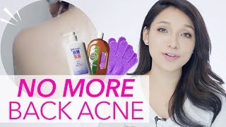 Get Rid of Back AcnePimple in ONE WEEK GDiipa [upl. by Marnie]