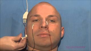 Motoric Neurography  Facial Nerve [upl. by Zelten]