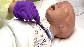 Surgical tracheostomy procedure [upl. by Nivek]