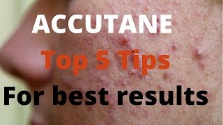 Accutane 5 tips by Dermatologists [upl. by Lavella]