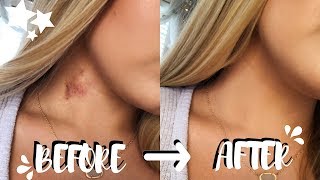 How To Get Rid Of Hickeys In Two EASY Steps no color correcting  Brooklyn Anne [upl. by Oballa897]