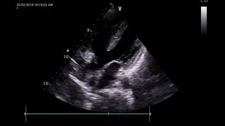 Tetralogy of Fallot TOF [upl. by Aruon951]