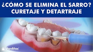 ¿Cómo se ELIMINA EL SARRO  Curetaje y limpieza dental © [upl. by Redyr]