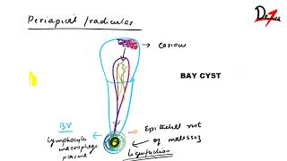 Radicular cyst  PATHOGENESIS CF RF amp TREATMENT [upl. by Barna]