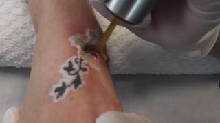 PicoWay Tattoo Removal [upl. by Shelah]