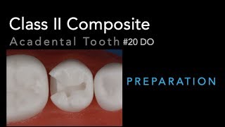 Class II Composite Preparation  Acadental Tooth 20 DO [upl. by Sivolc953]