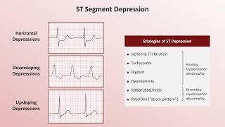 Intro to EKG Interpretation  QRST Changes [upl. by Anilram418]