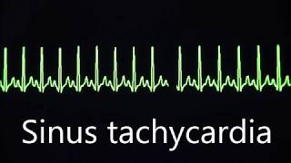 Cardiovascular System 8 Normal and abnormal heart rhythms [upl. by Rema]