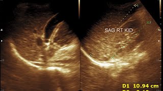 Chronic Liver Parenchymal Disease  Cirrhosis  Chronic Hepatitis [upl. by Casta]