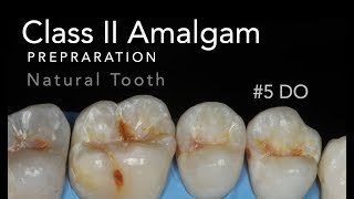 Class II Amalgam Preparation  5 DO Natural Tooth [upl. by Nesnah779]