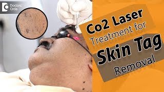 Skin Tag Removal in seconds using Cardondioxide Laser  Procedure  Dr Rajdeep Mysore [upl. by Sorips]