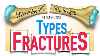 Bone Fracture Types amp Mechanisms  ANIMATION  Fracture classification  The Young Orthopod NEET PG [upl. by Jessa]