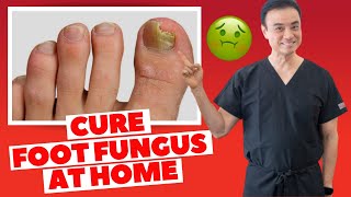 6 Effective HOME REMEDIES To CURE Toenail FUNGUS  Holistic Toenail Fungus Cures Part 2  Dr Kim [upl. by Ijar]