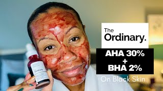 THE ORDINARY AHA 30  BHA 2 PEELING SOLUTION REVIEW HOW TO USE ON BLACK SKIN [upl. by Millur622]