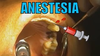 ANESTESIA DENTAL HD [upl. by Keen]