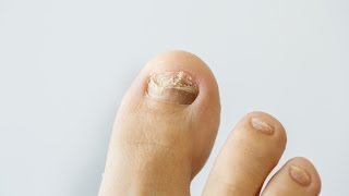 How to prevent and treat nail fungus [upl. by Becket]