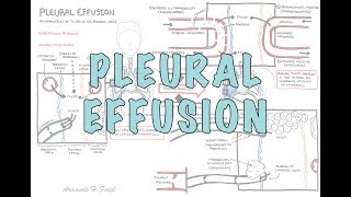 Pleural Effusion DETAILED  pathophysiology signs and symptoms treatment [upl. by Noskcaj]