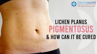 How to cure Lichen Planus Pigmentosus  Lichen Planus Pigmentosus Treatment  Dr Rohit Batra [upl. by Niwred]