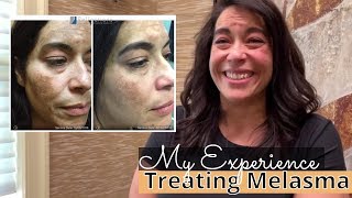 Melasma Treatment with Tranexamic Acid  My Experience  TreatmentResistant Melasma [upl. by Eikcuhc]