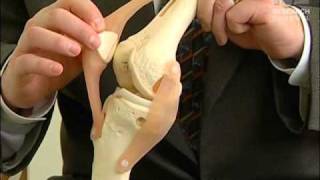 QuadricepsSparing Knee Replacement  UW Medicine [upl. by Nelleh]