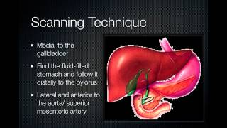 pyloric stenosis [upl. by Aisereht]