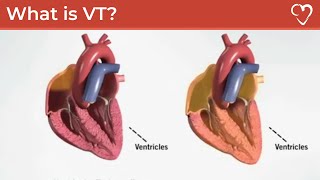 What is Ventricular Tachycardia VT [upl. by Airt]